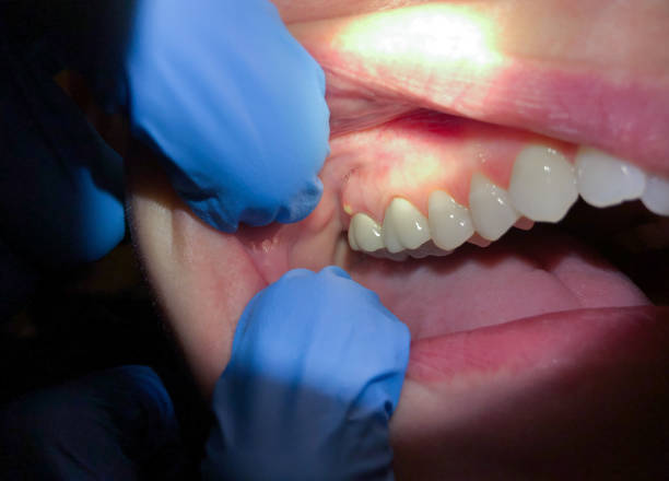 Best Dental Abscess Treatment in Clintondale, NY